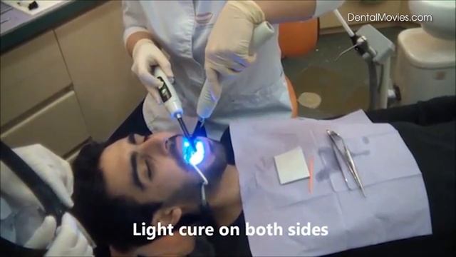 eBRACE - Bonding procedure of lingual appliance