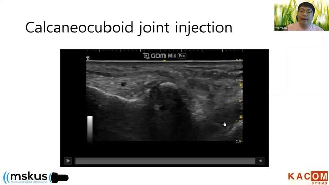 Dr. Yong Hyun Yoon talks about Interventional Ultrasound of the Ankle