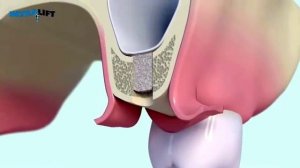 IntraLift® протокол | закрытый синус-лифтинг