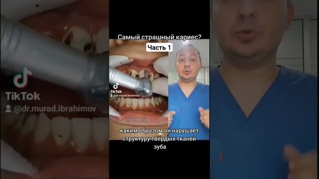 Самый страшный кариес Ч.1 #стоматолог #стоматология #кариес #лечениекариеса #зуб #зубы #азербайджан
