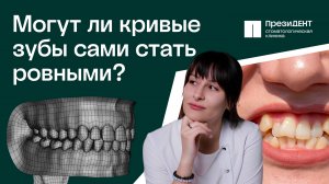 Скученность зубов:  МОГУТ ли зубы выровниться сами? Нужно ли удалять лишние зубы? |ПрезиДЕНТ💚