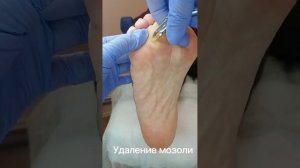 Удаление мозоли