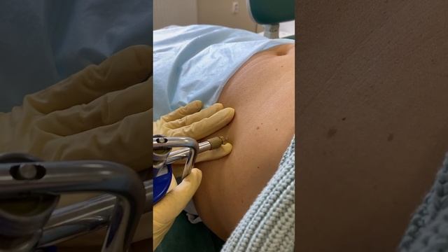 Как проходит процедура криодеструкции?