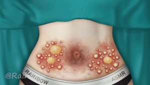 ASMR Remove Big Acne Worm Infected Belly Deep Cleaning Animation 2
