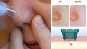 Вакуумный очиститель пор Spot Cleaner