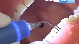 Использование насадки  PE 41A для скейлинга "LM-Dental"