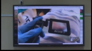 Интубация с помощью видеоларингоскопа и бужа