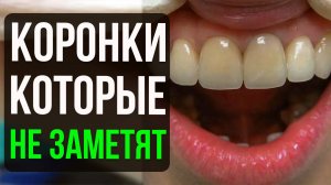 Какие коронки выбрать на передние зубы? 🦷 Советы стоматолога для идеальной улыбки!