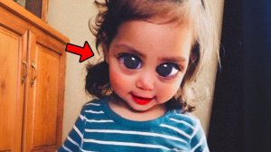 Помните девочку, родившуюся с огромными глазами? Вы не поверите, как она выглядит сейчас!