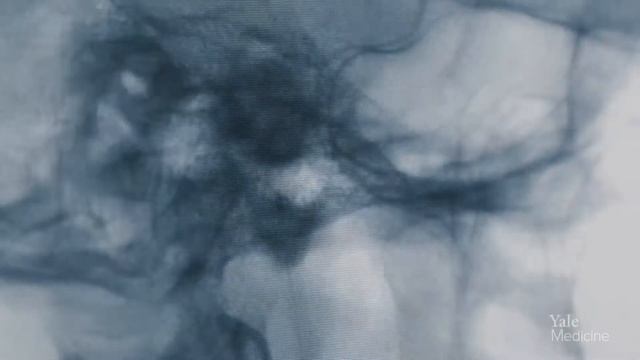 A New Way to Treat Brain Aneurysms смотреть онлайн