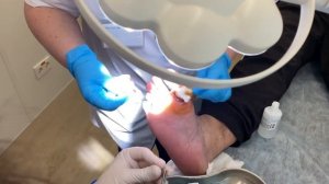 Наложение вторичных швов на рану