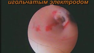Чистка после выкидыша осложнилась спайкой. Лечение.