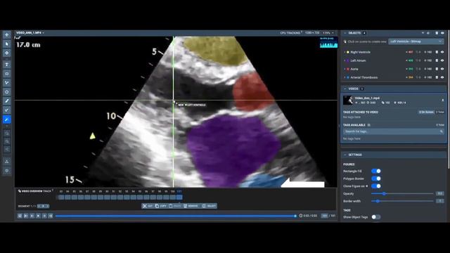 Heart segmentation on Ultrasound Videos with Supervisely and Custom Smart Tool смотреть онлайн