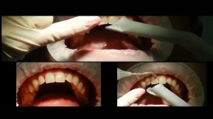 Профессиональная гигиеническая чистка ультразвук+Air flow