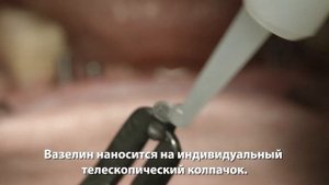 Снятие оттиска с уровня имплантата и установка мостовидного протеза из TRINIA®