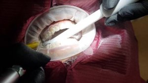 Профессиональная чистка зубов