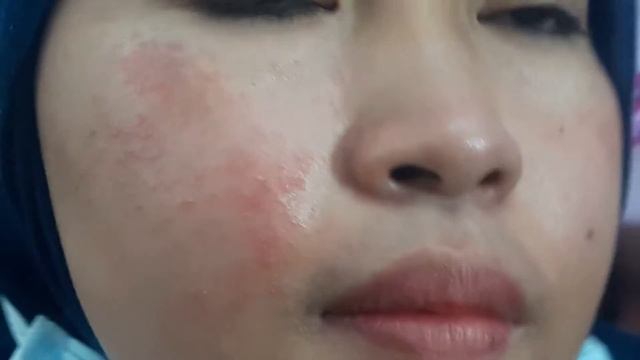 Tinea Faciei right cheek with suppuration + pustular acne chins смотреть онлайн