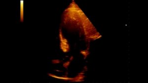 Контрастная эхокардиография в апикальной четырехкамерной позиции: видео 5 из 9