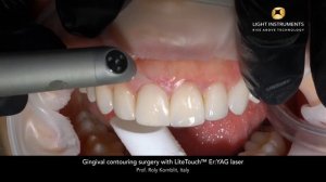 Хирургическое контурирование десны с помощью лазера LiteTouch™ Er:YAG