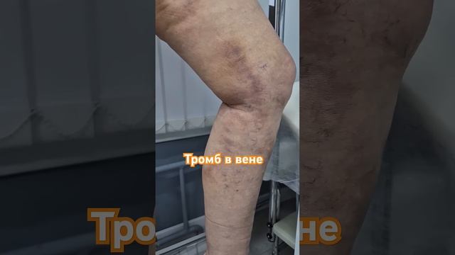 Так выглядит тромбофлебит. Флеболог Москва.