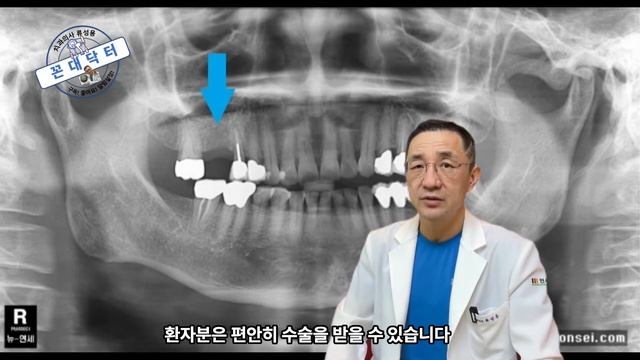 무절개 임플란트 최소절개 임플란트 플랩리스 임플란트 수술법의 장점 및 단점 적응증 flapless implant surgery #임플란트 #임플란트수술 #치과