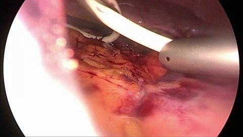 Лапароскопическая холедохолитотомия