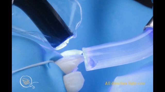 Class IV restorations using layering technique , trauma of central incisors for a boy