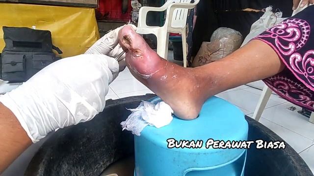 PELUK59, luka diabetes korban herbal tak bertanggung jawab смотреть онлайн