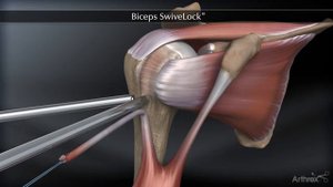 Arthrex   Biceps SwiveLock®