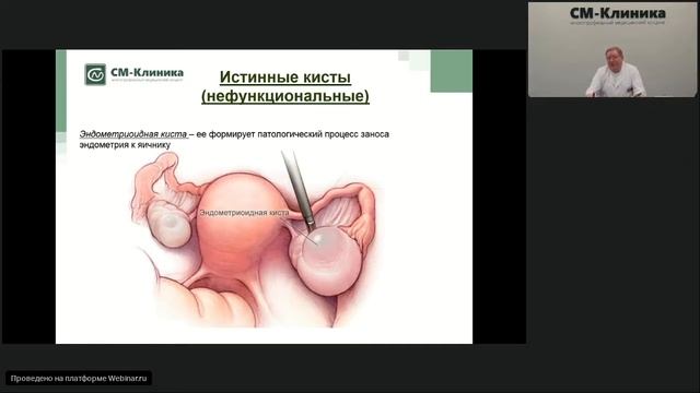 Запись вебинара «Доброкачественные опухоли яичников» - Чернявский Е.Я. (06.08.2019)