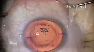 Фемтосекундный лазер VICTUS  Фемтосекундная хирургия катаракты