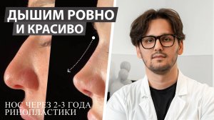 Нос  через 2-3 года после ринопластики