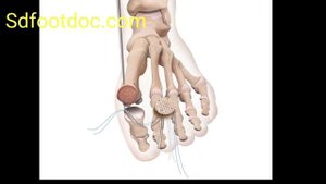 Hallux rigidus Cartilage replacement with Cartiform