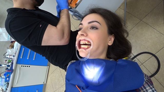 УСТАНОВКА БРЕКЕТОВ смотреть онлайн