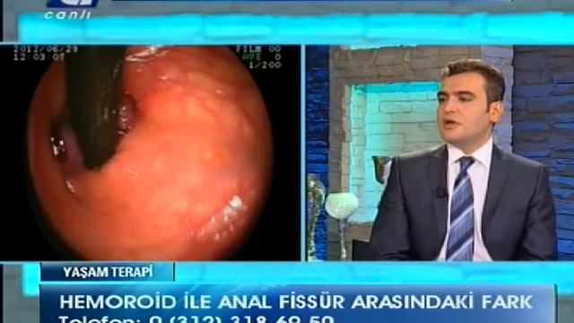 Hemoroid ve anal fissür arasındaki fark nedir? смотреть онлайн