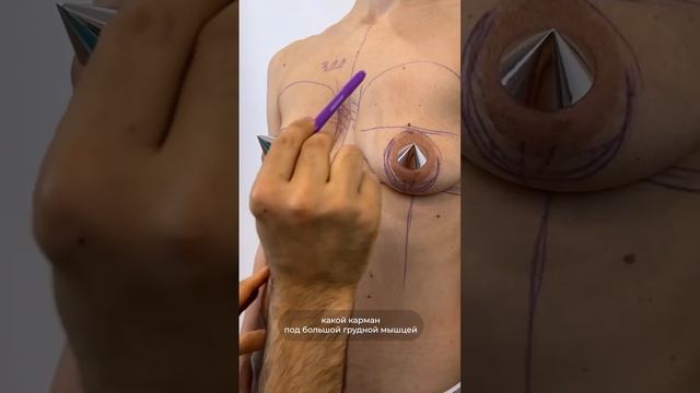 МАММОПЛАСТИКА С ИМПЛАНТАМИ. Доктор Карапетян
