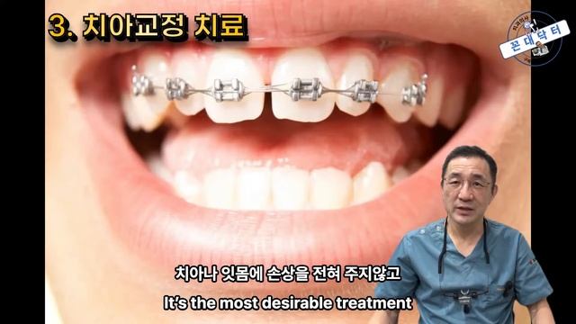 벌어진 앞니 사이 공간 치료법 3가지  Diastema Closure