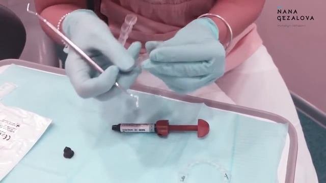 Новейшая ортодонтия: Invisalign. Фиксация аттачментов