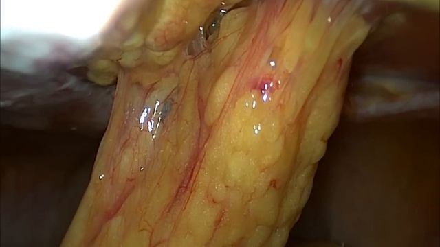 7 сутки после КС по Штарку смотреть онлайн