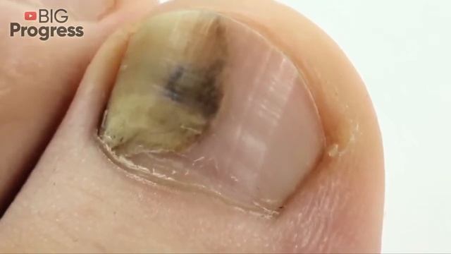 CURE Toenail Fungus for Less than $0.50 смотреть онлайн