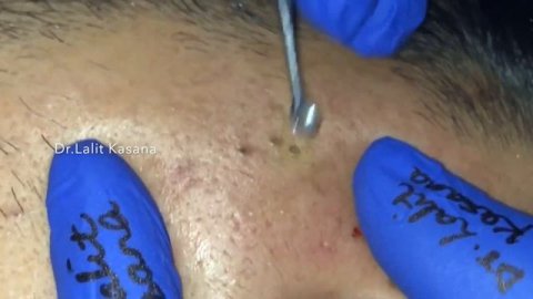 BLACKHEADS REMOVAL BY DR LALIT KASANA