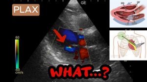 РЕГУРГИТАЦИЯ НА ВСЕХ КЛАПАНАХ ОДНОГО ПАЦИЕНТА #узи #эхокг #сердце #кардиология #медицина #ultrasoun
