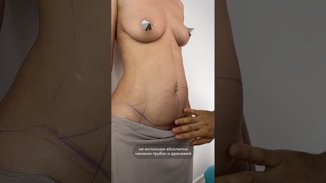 КОМПЛЕКСНАЯ АБДОМИНОПЛАСТИКА С ЛИПОСАКЦИЕЙ. Часть 1. Доктор Карапетян