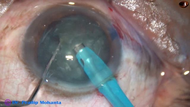 Bimanual IA in a routine Phacosurgery : Pradip Mohanta, 16th May, 2020 смотреть онлайн