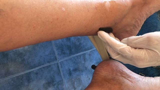 Тромбофлебит (Тромб) Флеботромбоза и Спукани Капиляри по Краката - Лечение с Медицински Пиявици смотреть онлайн