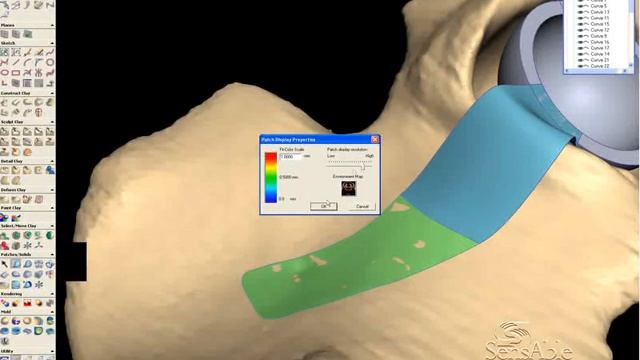 [FreeForm systems] 환자 맞춤형 비구컵 임플란트 смотреть онлайн