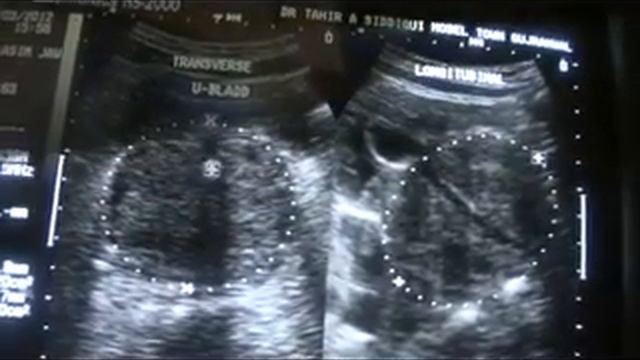 ultrasound how to scan PROSTATE 3 0F 3 смотреть онлайн