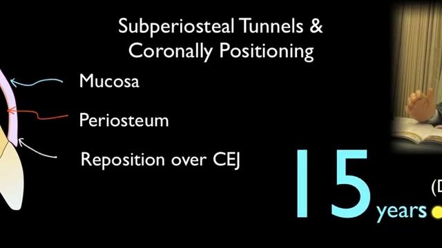 VISTA for recession defect смотреть онлайн