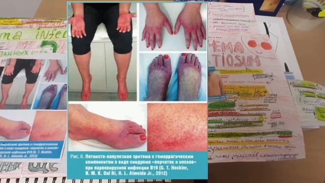 Парвовирусная инфекция смотреть онлайн