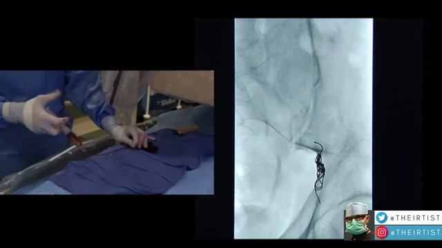How to remove varicocele without Surgery ?  The Sandwich Technique by Interventional Radiology